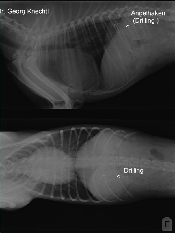 Entfernung Angelhaken mittels Endoskopie / Gastroskopie / Rntgenbild